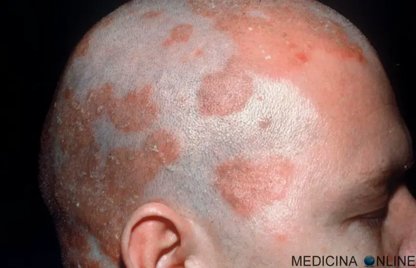 MEDICINA ONLINE DERMATITE SEBORROICA IMMAGINI NUCA CUOIO CAPELLUTO CAPELLI UOMO DONNA FINASTERIDE ALOPECIA AREATA O ANDROGENETICA DIFFERENZE CALVIZIE PELO CAPELLO RASATO DECORSO