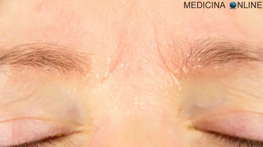 MEDICINA ONLINE DERMATITE SEBORROICA IMMAGINI NUCA CUOIO CAPELLUTO CAPELLI UOMO DONNA FINASTERIDE ALOPECIA AREATA O ANDROGENETICA DIFFERENZE CALVIZIE PELO CAPELLO RASATO DECORSO