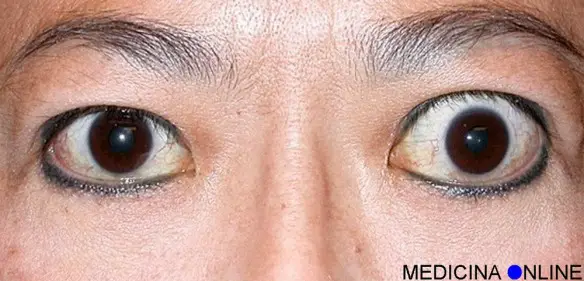 medicina online esoftalmo cause sintomi terapie occhio sporgente immagini foto.jpg