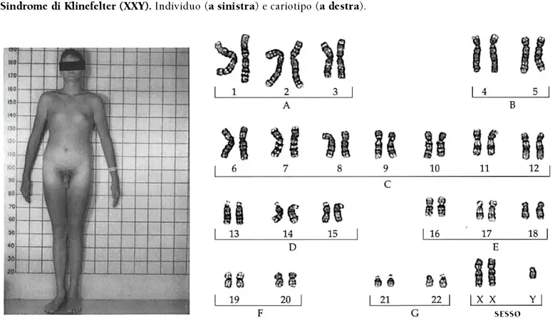 MEDICINA ONLINE SINDROME KLINEFELTER CARIOTIPO CAUSE SINTOMI CURA GENETICA MALATTIA