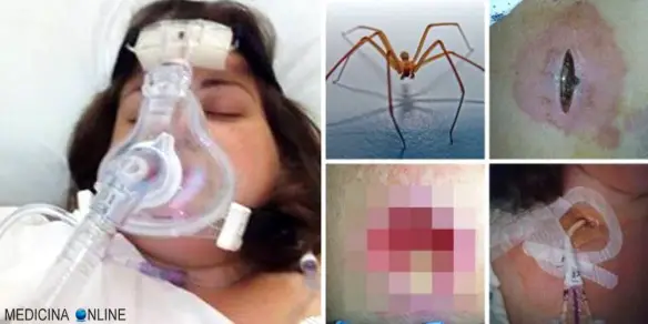 MEDICINA ONLINE CLARESSA COLEMAN SPIDER BITE DEATH DEAD RISCHIA DI MORIRE PUNTURA MORSO RAGNO INSETTO RAGAZZA GIOVANE ANIMALE VELENO CRONACA.jpg