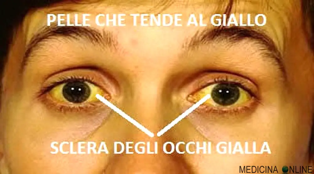 MEDICINA ONLINE ITTERO BILIRUBINA EMOLITICO COLESTATICO OSTRUTTIVO NEONATALE SIGNIFICATO CISTIFELLEA SCLERA COLECISTI BILE GRASSI DIGESTIONE DOTTO CISTICO COLEDOCO COMUNE FEGATO PANCREA