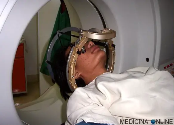 MEDICINA ONLINE CURA STEREOTATTICA STEREOTASSICA RADIOCHIRURGIA RADIOTERAPIA SISTEMICA REGIONALE LOCALE CHIRURGIA FARMACO FA PIU MALE CHEMIOTERAPIA RAGGI X RADIOGRAFIA TAC FA MORIRE TUMORE CANCRO