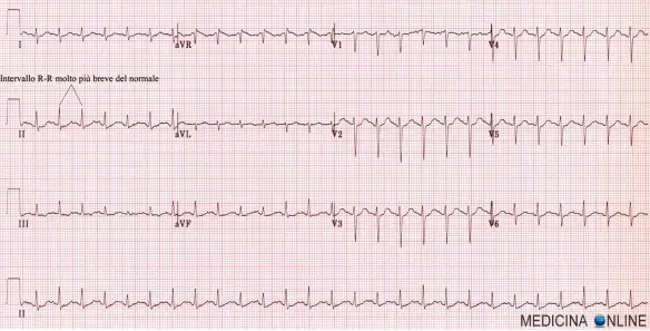 MEDICINA ONLINE ELETTROCARDIOGRAMMA SINUSALE DEFIBRILLATORE CARDIOVERSIONE SPONTANEA ELETTRICA CON SHOCK FARMACOLOGICA FARMACI URGENZA EMERGENZA MASSAGGIO CARDIACO ARRESTO RESPIRAZIONE BOCCA RIANIMAZIONE ECG FIBRILLATORE.jpg