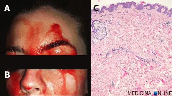 MEDICINA ONLINE EMATOIDROSI SUDARE SANGUE SUDORE PORI PELLE SANGUINARE EMORRAGIA STUDIO LETTERATURA SCIENTIFICA hematohidrosis-describes-the-condition-in-which-blood-comes-out-of-unbroken-pores.jpeg