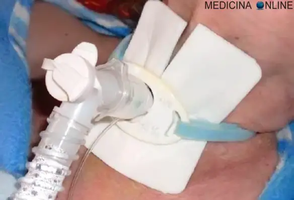 MEDICINA ONLINE Tracheotomy TRACHEOTOMIA TRACHEA ELETTROCARDIOGRAMMA SINUSALE INTUBAZIONE ENDOTRACHEALE TRACHEA TUBO FARMACI URGENZA EMERGENZA MASSAGGIO CARDIACO ARRESTO RESPIRAZIONE BOCCA RIANIMAZIONE.jpg