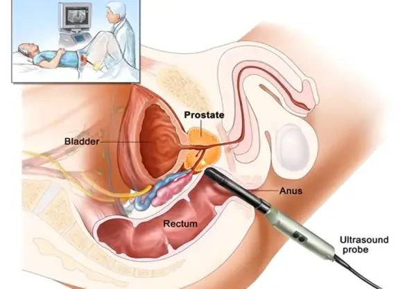 MEDICINA ONLINE ECOGRAFIA PROSTATICA TRANSRETTALE SONDA RETTO ANO PROSTATA TENE GHIANDOLA IPERPLASIA IPERTROFIA PROSTATICA BENIGNA CANCRO TUMORE UMO ULTRASUONI.jpg