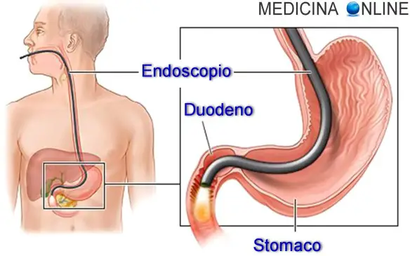 MEDICINA ONLINE GASTROSCOPIA STOMACO DUODENO INTESTINO CRASSO ILEO CIECO APPENDICE ASCENDENTE TRASVERSO DISCENDENTE SIGMA RETTO ANO COLONSCOPIA RETTOSCOPIA SIGMOIDOSCOPIA TUMORE ANOSCOPIA PANCOLONSCOPIA RETTOSIGMO