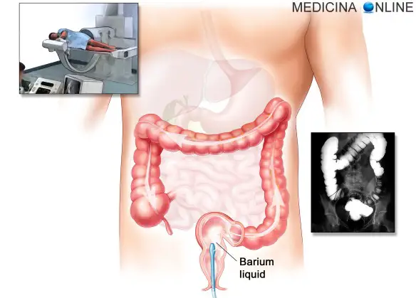 MEDICINA ONLINE INTESTINO CLISMA OPACO BARIO LIQUIDO MEZZO DI CONTRASTO CRASSO ILEO CIECO APPENDICE ASCENDENTE TRASVERSO DISCENDENTE SIGMA RETTO ANO COLONSCOPIA RETTOSCOPIA SIGMOIDOSCOPIA TUMORE ANOSCOPIA PANCOLONSCOPIA