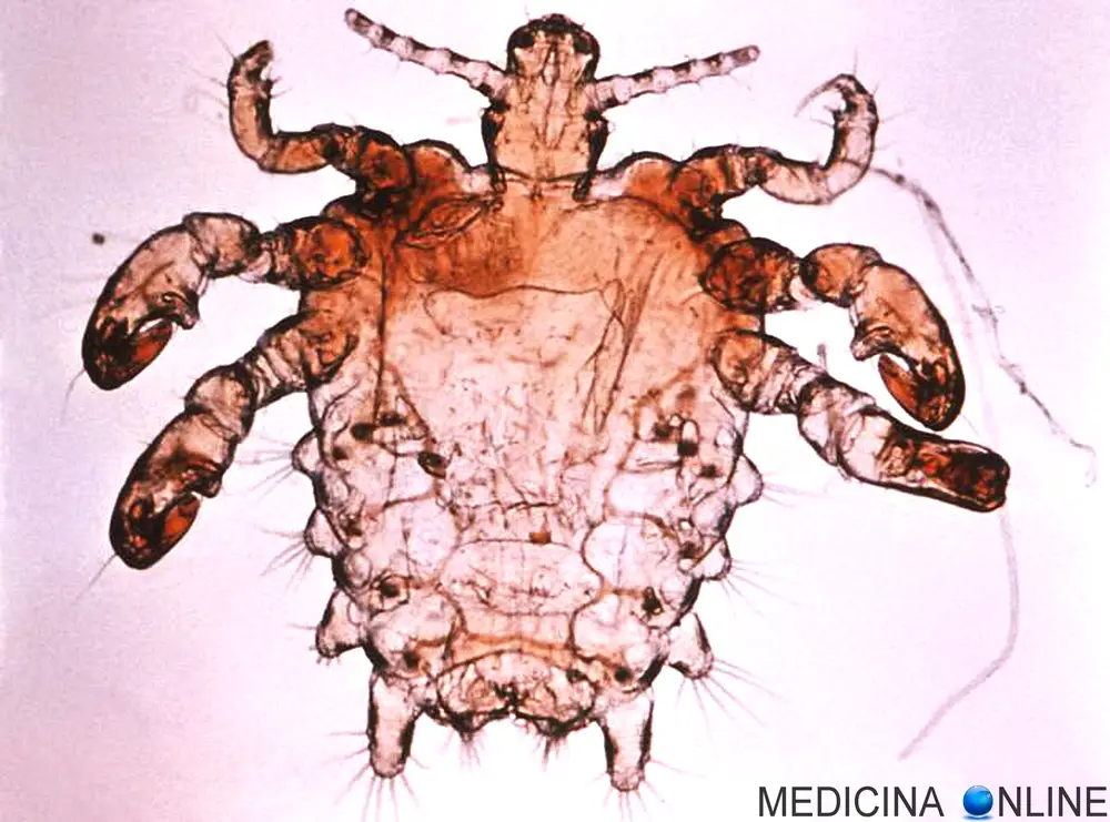 MEDICINA ONLINE PTHIRUS PUBIS PIATTOLA PIDOCCHIO DEL PUBE PUBE CIGLIA SOPRACCIGLIA PARASSITA PIDOCCHI PARASSITI ACETO QUANTO DURA INFEZIONE RAGNO PELLE ROSSORE PELI CAPELLI PRODOTTI ELIMINARE SESSO PARTNER 2.jpg