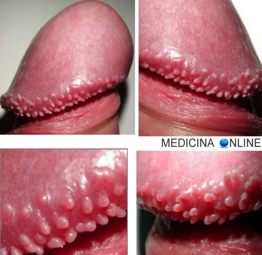 MEDICINA ONLINE GLANDE DEL PENE