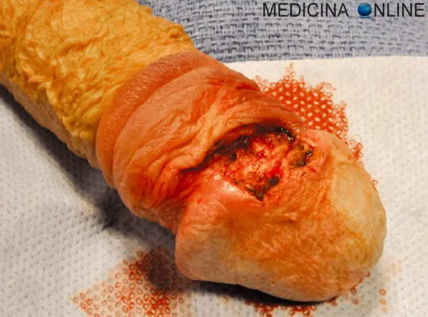 MEDICINA ONLINE GLANDE DEL PENE