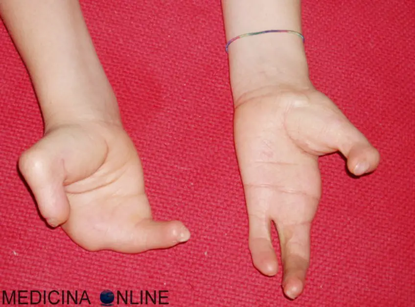 MEDICINA ONLINE POLIDATTILIA ECTRODATTILIA MALFORMAZIONE MANI PIEDI ARACNODATTILIA MANO DITA SCHELETRO RAGNO SEGNO DEL POLLICE SEGNO DEL POLSO SINDROME DI MARFAN DI BEALS SEMEIOTICA MEDICA DITA LUNGHE