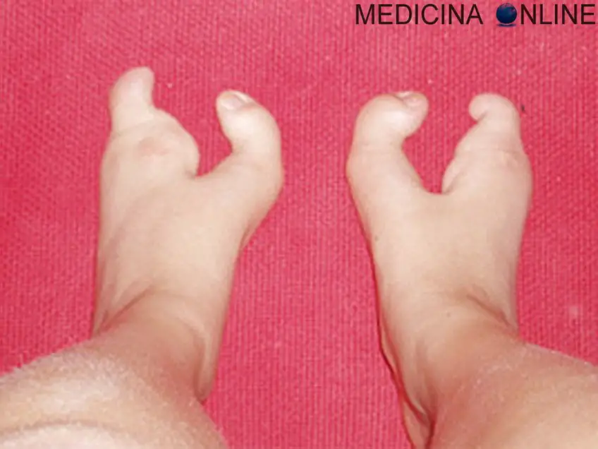 MEDICINA ONLINE POLIDATTILIA ECTRODATTILIA MALFORMAZIONE MANI PIEDI ARACNODATTILIA MANO DITA SCHELETRO RAGNO SEGNO DEL POLLICE SEGNO DEL POLSO SINDROME DI MARFAN DI BEALS SEMEIOTICA MEDICA DITA LUNGHE