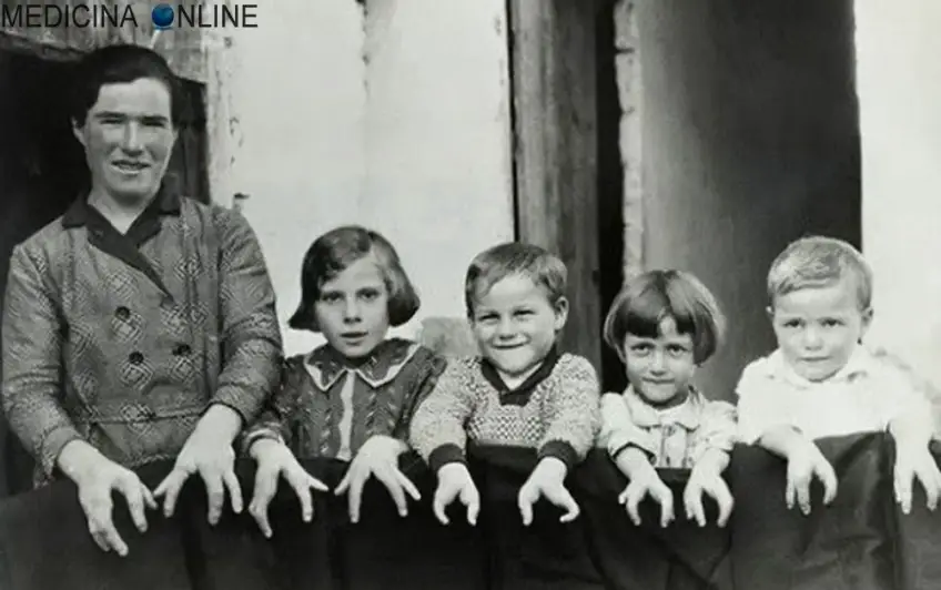 MEDICINA ONLINE POLIDATTILIA ECTRODATTILIA MALFORMAZIONE MANI PIEDI ARACNODATTILIA MANO DITA SCHELETRO RAGNO SEGNO DEL POLLICE SEGNO DEL POLSO SINDROME DI MARFAN DI BEALS SEMEIOTICA MEDICA DITA LUNGHE