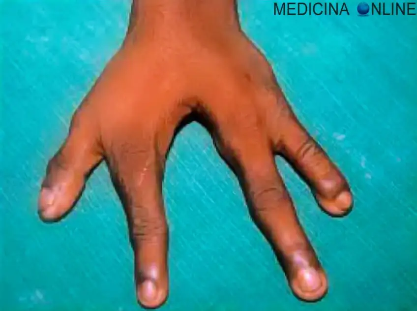 MEDICINA ONLINE POLIDATTILIA ECTRODATTILIA MALFORMAZIONE MANI PIEDI ARACNODATTILIA MANO DITA SCHELETRO RAGNO SEGNO DEL POLLICE SEGNO DEL POLSO SINDROME DI MARFAN DI BEALS SEMEIOTICA MEDICA DITA LUNGHE