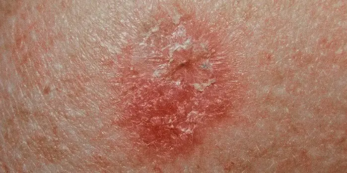 MEDICINA ONLINE IMMAGINI cheratosi