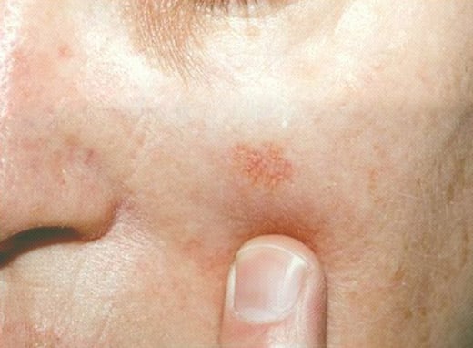 MEDICINA ONLINE IMMAGINI cheratosi