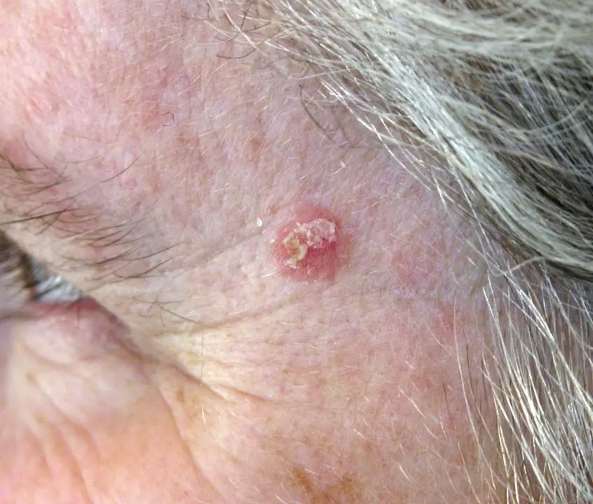 MEDICINA ONLINE IMMAGINI cheratosi