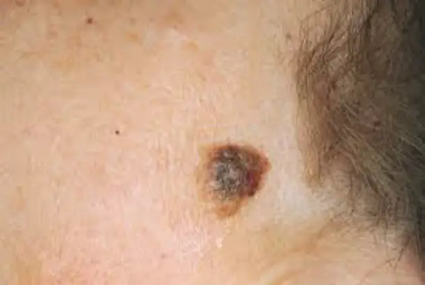 MEDICINA ONLINE IMMAGINI cheratosi