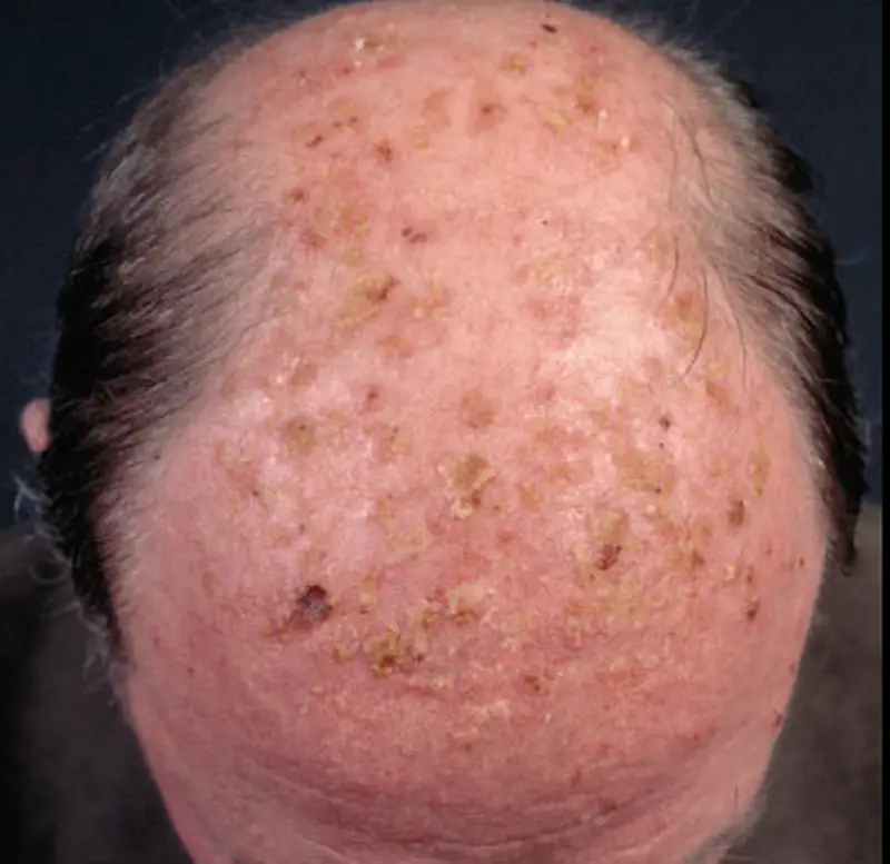 MEDICINA ONLINE IMMAGINI cheratosi