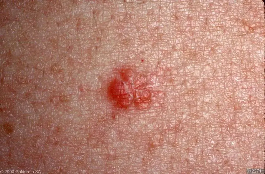 MEDICINA ONLINE IMMAGINI cheratosi