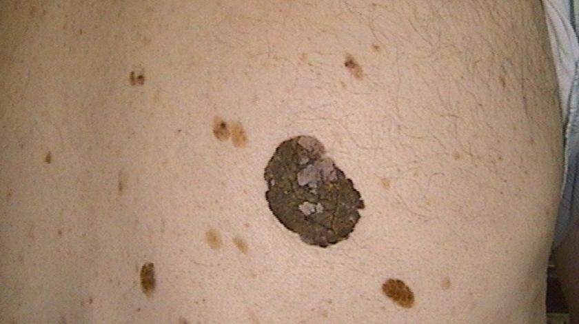 MEDICINA ONLINE IMMAGINI cheratosi