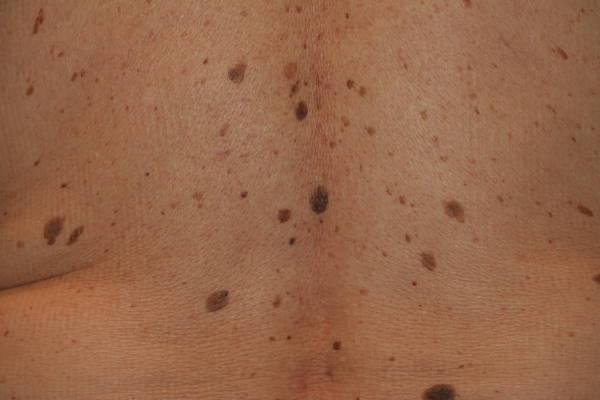 MEDICINA ONLINE IMMAGINI cheratosi