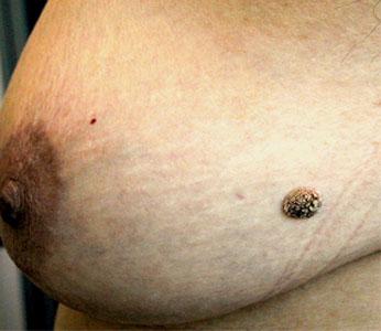 MEDICINA ONLINE IMMAGINI cheratosi