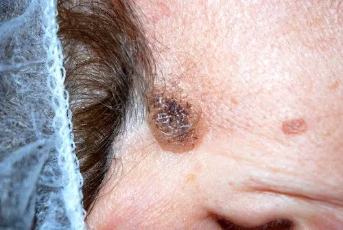 MEDICINA ONLINE IMMAGINI cheratosi