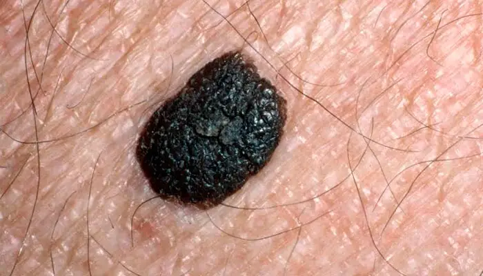 MEDICINA ONLINE IMMAGINI cheratosi