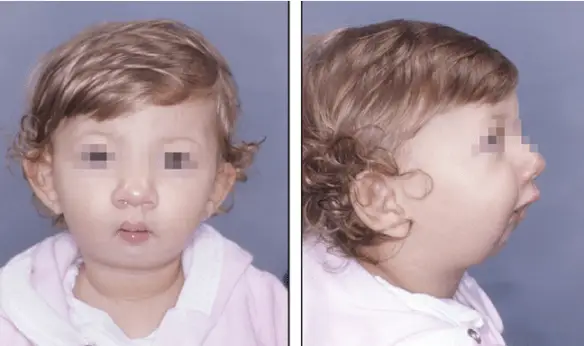 MEDICINA ONLINE MICROGNAZIA MANDIBOLA POLIDATTILIA ECTRODATTILIA MALFORMAZIONE MANI PIEDI ARACNODATTILIA MANO DITA SCHELETRO RAGNO SEGNO DEL POLLICE SEGNO DEL POLSO SINDROME DI MARFAN DI BEALS Richieri Costa Pereira.png