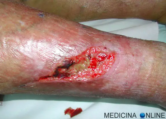 MEDICINA ONLINE ULCERA CUTANEA ARTERIOSA VENOSA INSUFFICIENZA  DIABETE FERITA LESIONE ABRASIONE CONTUSIONE PIAGA ESCORAZIONE DIFFERENZA RIPARAZIONE INTENZIONE ASETTICA MORSO SQUALO PIEDE DOLORE SANGUE VIOLENTA BISTURI.jpg