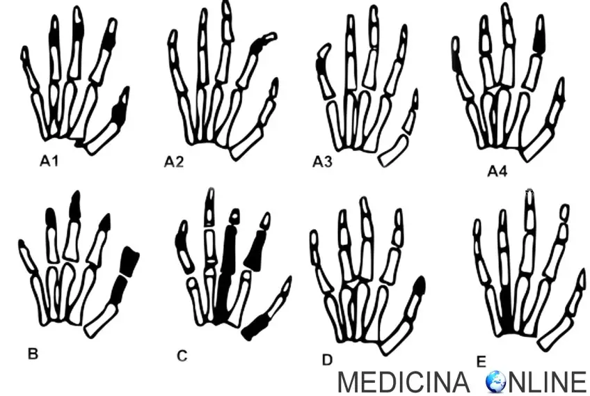 MEDICINA ONLINE BRACHIDATTILIA BRACHYDACTYLY