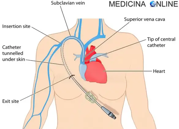 MEDICINA ONLINE CANNULA CATETERE INFERMIERE AGOCANNULA VENOSO CENTRALE NUTRIZIONE ENTERALE PARENTERALE TOTALE PERIFERICA ASSISTITA ARTIFICIALE SANGUE SACCA SONDINO NASO GASTRICO VENA LINEE GUIDA Placement of intravenous