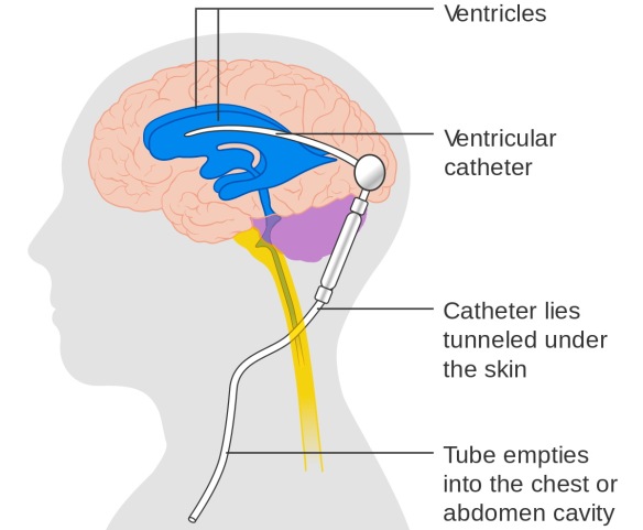 MEDICINA ONLINE CERVELLO SHUNT CEREBRALE VENTRICOLI IDROCEFALO LIQUOR LIQUIDO CEFALORACHIDIANO.jpg