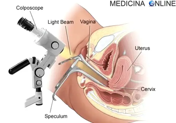 MEDICINA ONLINE Colposcopy COLPOSCOPIA OVAIO TUBE FALLOPPIO OVAIA OOCITA OVOCELLULA SPERMATOZOO UTERO VAGINA FONDO CERVICE TUMORA CANCRO POLICISTICO SALPINGOGRAFIA ECOGRAFIA STERILITA GRAVIDANZA INCINTA INFERTILE.jpg