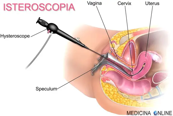 MEDICINA ONLINE Hysteroscopy OVAIO TUBE FALLOPPIO OVAIA OOCITA OVOCELLULA SPERMATOZOO UTERO VAGINA FONDO CERVICE TUMORA CANCRO POLICISTICO SALPINGOGRAFIA ECOGRAFIA STERILITA GRAVIDANZA I