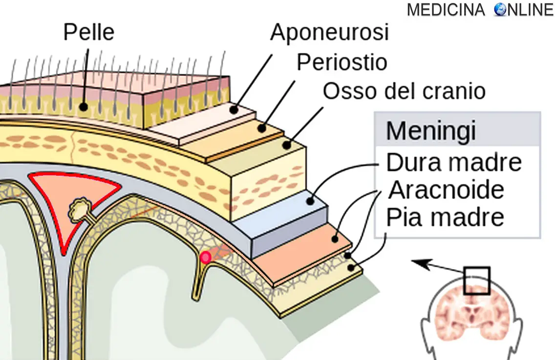 Differenza Tra Ictus E Emorragia Cerebrale Differenza tra emorragia cerebrale, intra-assiale e extra-assiale