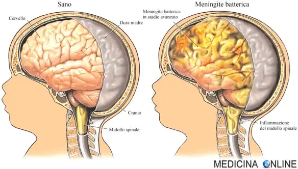 MEDICINA ONLINE MENINGITE VIRALE BATTERICA BAMBINI NEONATO ADULTO MENINGI LIQUOR PUNTURA LOMBARE CERVELLO RACHICENTESI CRANIO ENCEFALO INFEZIONE INFIAMMAZIONE BATTERI VIRUS EMORRAGIA.jpg