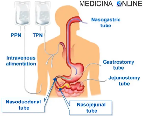 MEDICINA ONLINE NUTRIZIONE ENTERALE PARENTERALE TOTALE PERIFERICA ASSISTITA ARTIFICIALE MASTICAZIONE DIGESTIONE SANGUE SACCA SONDINO NASO GASTRICO VENA CATETERE DIETA DIETOLOGIA CANNULA SALINA GLUCOSIO SOLUZIONE