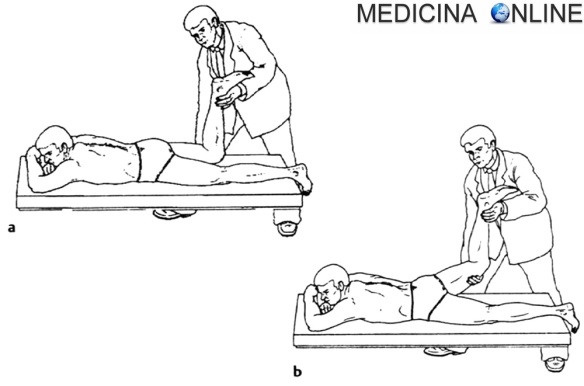 Compresión radicular. Signo femoral de Lasègue o Lasègue invertido