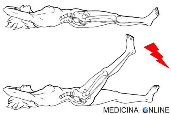 MEDICINA ONLINE SEGNO DI LASEGUE POSITIVO NEGATIVO SEDUTO SDRAIATO IRRITAZIONE MENINGI MENINGISMO MENINGITE INFEZIONE INFIAMMAZIONE LASEGUE sign ERNIA SCIATICA NERVO DOLORE SEMEIOTICA.jpg