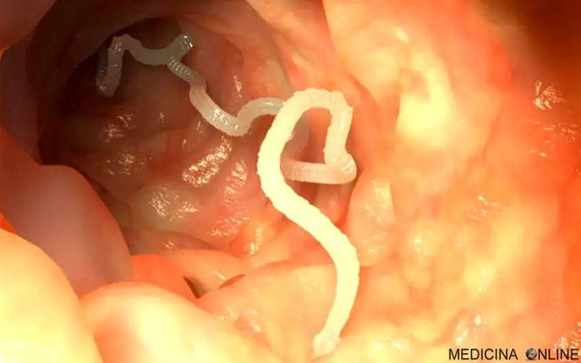 MEDICINA ONLINE TAENIA SOLIUM TENIA VERME SOLITARIO INTESTINO pork tapeworm infection