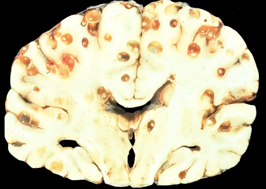 MEDICINA ONLINE TAENIA SOLIUM TENIA VERME SOLITARIO INTESTINO pork tapeworm infection
