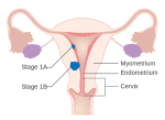 MEDICINA ONLINE TUMORE ENDOMETRIO STADIO