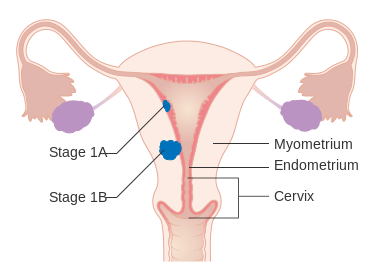 MEDICINA ONLINE TUMORE ENDOMETRIO STADIO