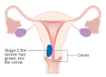 MEDICINA ONLINE TUMORE ENDOMETRIO STADIO