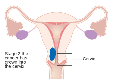 MEDICINA ONLINE TUMORE ENDOMETRIO STADIO