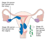 MEDICINA ONLINE TUMORE ENDOMETRIO STADIO